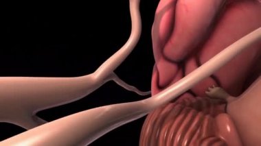 Beyne giden damar tıkanır ve beyin kanaması meydana gelir.