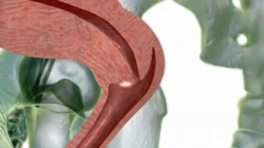 Kanser için metastaz vücudun başlangıcından farklı bir yerine yayılır..