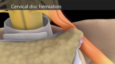 Omurga kemiğinin omurgası anatomik görünüm ile omurgalar arası disk-sıkıştırıcı sinir kökü sarkması