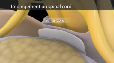 Omuriliğe çarpmış.