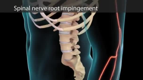 Anatomische Weergave Van Cervicale Wervelkolom Met Intervertebrale Schijf Compressieve Zenuwwortel — Stockvideo