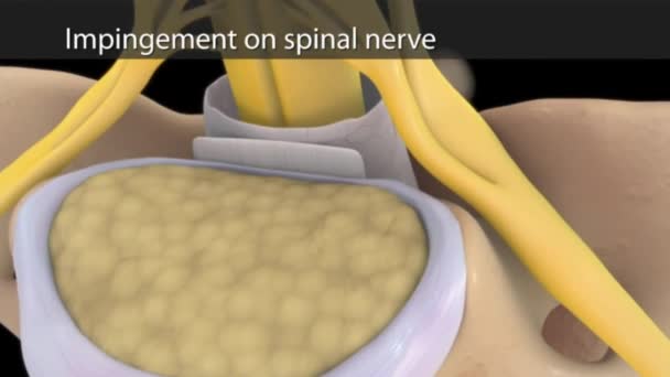 Auswirkungen Auf Den Spinalnerv — Stockvideo