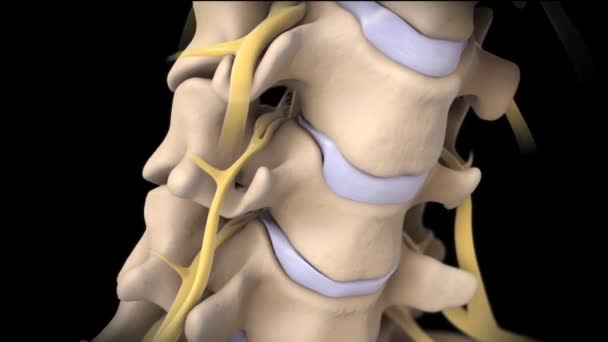由于椎间盘爆裂 它对骨骼和骨骼造成了压力 — 图库视频影像