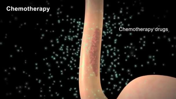 Brachiterapia Tipo Radioterapia Sorgente Radioattiva Collocato Adiacente Alla Regione Che — Video Stock