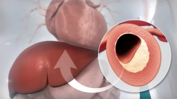 Atherosklerose Cholesterin Plaque Der Arterie — Stockvideo