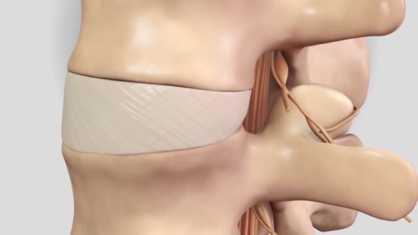 因椎间盘骨折而对神经造成的压力 — 图库视频影像