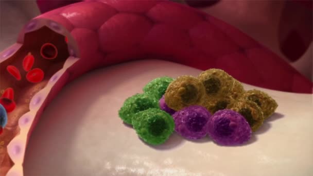 Mielom Multiplu Tip Cancer Care Constă Din Celule Albe Din — Videoclip de stoc