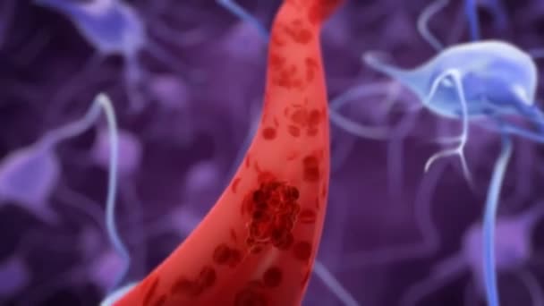 Vascular Occlusion Blockage Blood Vessel Usually Clot Heart Attac — Stock Video