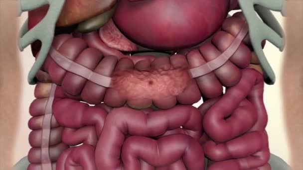 Colon Lors Une Entéroscopie Avec Tumeur Cancer Intestin Intestin Visible — Video