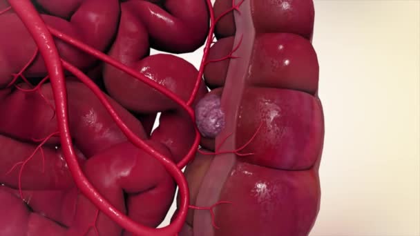 Colon Lors Une Entéroscopie Avec Tumeur Cancer Intestin Intestin Visible — Video