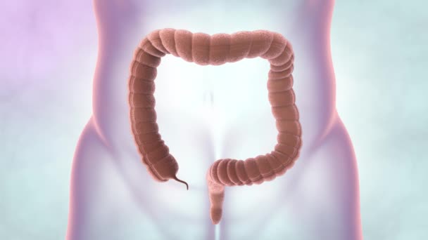 Colon Tijdens Een Enteroscopie Met Een Zichtbare Darm Darmkanker Tumor — Stockvideo