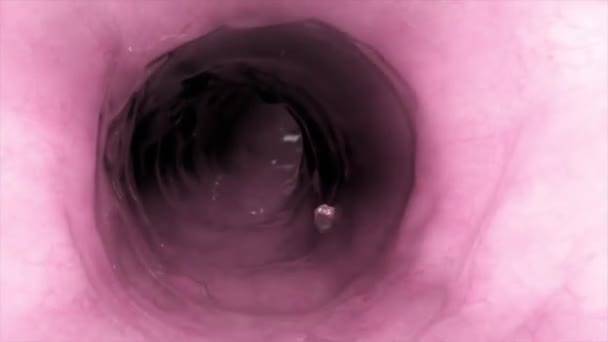 腸癌または腸癌の腫瘍が見える内視鏡検査中のコロン — ストック動画