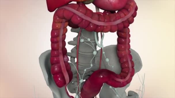 Colon Durante Enteroscopia Con Tumore Intestinale Intestinale Visibile — Video Stock