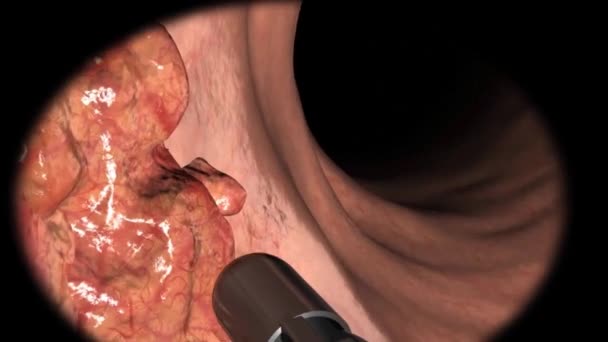 Colonoscopie Biopsie Van Het Gastro Intestinale Spoor Bij Patiënten — Stockvideo