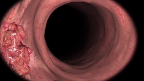 Biopsie Par Coloscopie Tractus Gastro Intestinal Chez Les Patients — Video