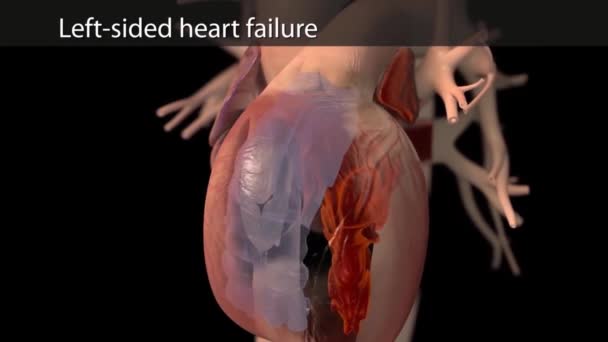 Left Sided Heart Failure — Stock Video