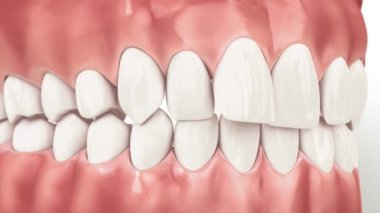 Diş telleri ya da görünmez diş telleri ısırık düzeltmesini sağlar. Tıbben doğru