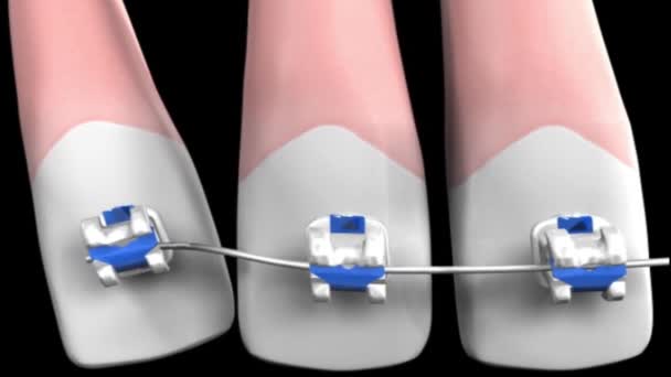 Zahnchirurgie Animation Von Zähnen Zahnspangen Konzept — Stockvideo