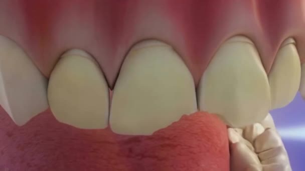 修理前の損傷歯のケア — ストック動画