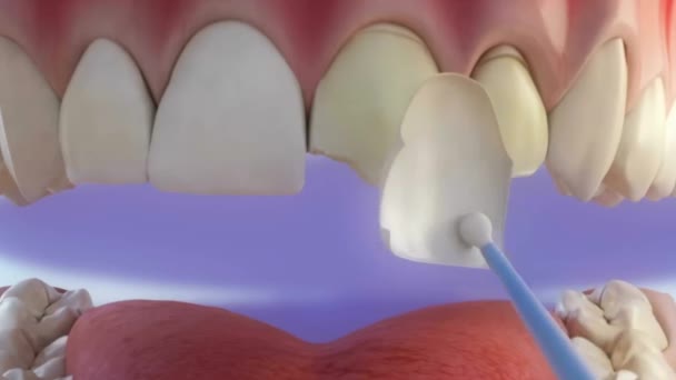 Processo Revestimento Dentário Secagem Com Feixe Adesivo — Vídeo de Stock