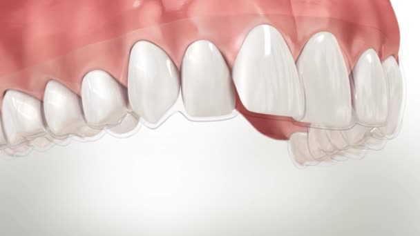 Processo Rivestimento Dei Denti Essiccazione Con Fascio Adesivo — Video Stock