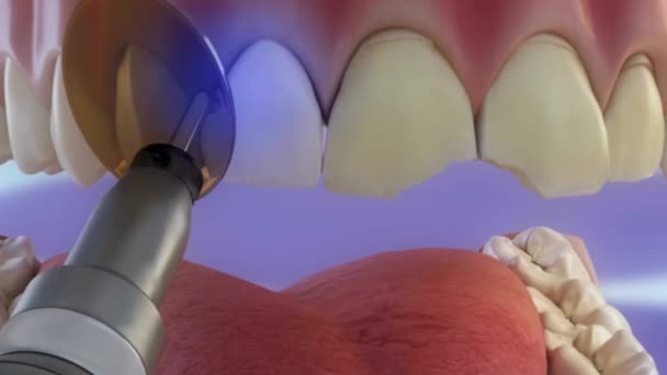 Processo Rivestimento Dei Denti Essiccazione Con Fascio Adesivo — Video Stock