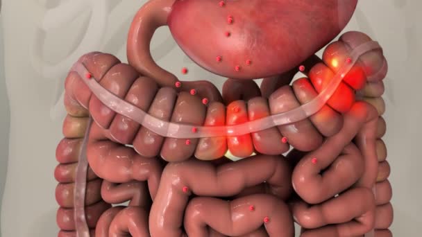 Estômago Fracassado Ferido Cancro Problema Tecido Tumoral Metástases Problemas Saúde — Vídeo de Stock