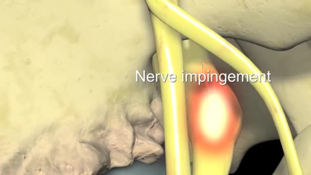 Medical Animatied Intervertebral Disc Nerve Impingement — Stock Video