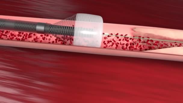 Oclusión Vascular Bloqueo Vaso Sanguíneo Generalmente Con Coágulo — Vídeos de Stock
