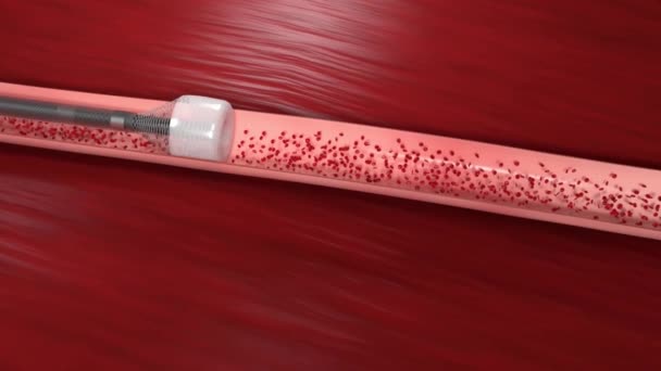 血管阻塞是指血管阻塞 通常带有血栓 — 图库视频影像