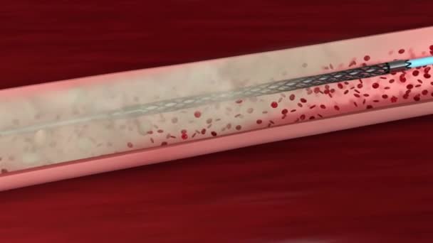 Oklusi Vaskular Adalah Penyumbatan Pembuluh Darah Biasanya Dengan Gumpalan Darah — Stok Video