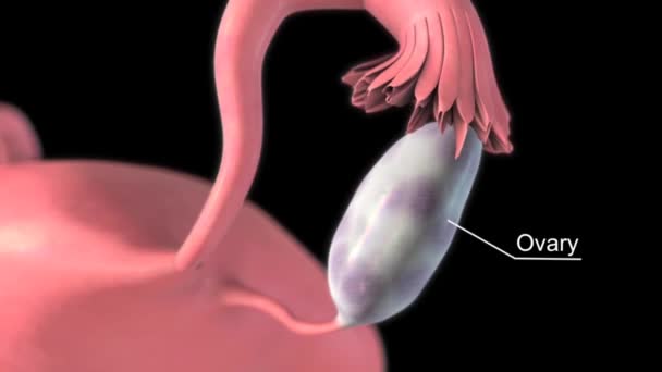 Комбінована Клітина Мікроорганізмів Стромальна Пухлина Яєчників — стокове відео