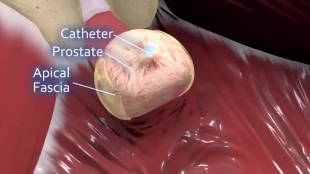 Prostata Masculina Dolor Próstata Exploración Corporal Articulación Examen Médico — Vídeo de stock