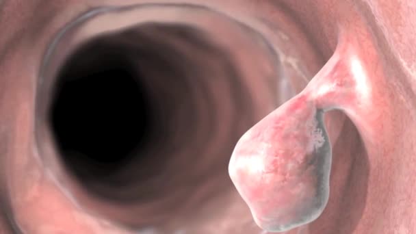 结肠镜检查发现的结肠癌 晚期腺瘤息肉的风险 — 图库视频影像