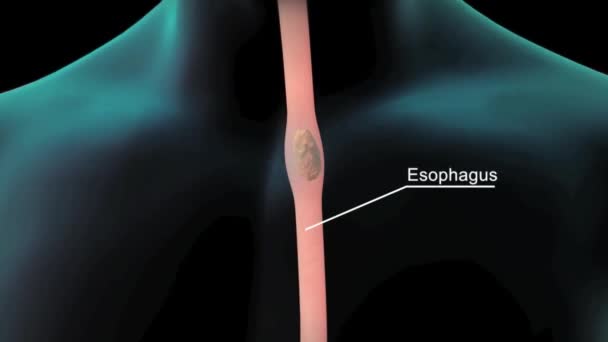 Journey Food Passing Esophagus Stomach — Stock Video