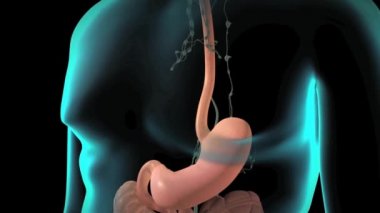 Skuamöz hücre kanseri - Yemek borusu tümörü büyüyor