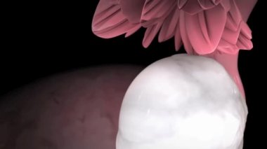 Dişi üreme sistemi, adhezyonlar, endometriom.