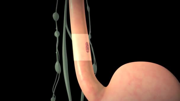 Tumori Dell Esofago Animazione Medica — Video Stock