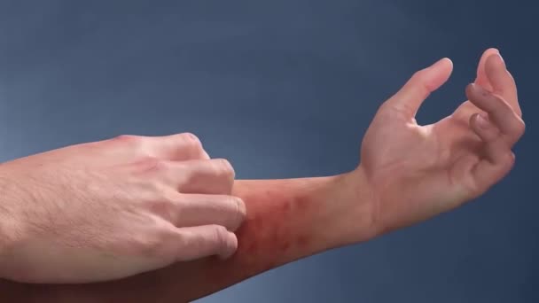 Αλλεργική Αντίδραση Και Κνησμός Προκαλούν Πληγές Στο Χέρι — Αρχείο Βίντεο