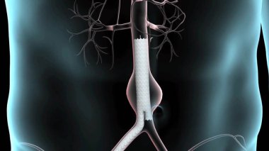 Büyük Abdominal Aort Anevrizması