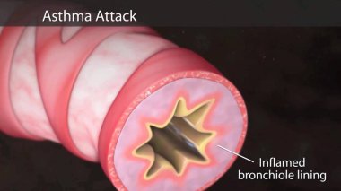 Astım illüstrasyon insan ciğerlerine bronşlarla saldırıyor. Döngü hareketi canlandırılmış 3D model.