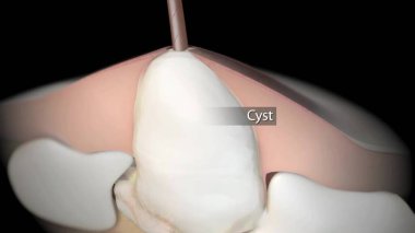 Yüzünde iltihaplı sivilce ve beyaz irin var. Asyalı genç adamın yüzünde kışkırtıcı Purulent sivilceleri var. Yüzündeki iltihaplı sivilce. Deri problemleri kavramı..