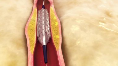 Angio Therapy. Stent placement in the artery. clipart