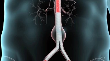 Abdominal aort anevrizması. Abdominal atardamar dolaşım sistemi. Abdominal aort ve anevrizmalı karın aortu sağlıklı. Siyah arkaplanda izole edilmiş düz biçim illüstrasyon