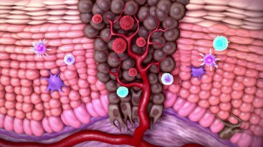 Melanoma ya da cilt kanseri. İnsan derisinin katmanları.