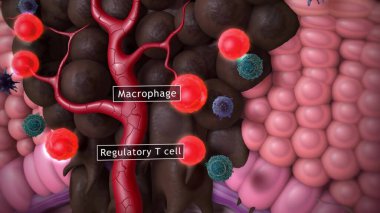 Melanoma ya da cilt kanseri. İnsan derisinin katmanları.