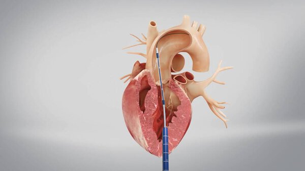 Aortic prosthesis surgery attachment of artificial prosthetic aortic valve to heart in animated human model
