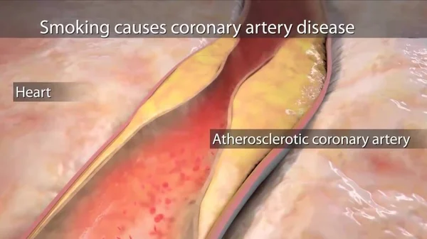 smoking causes coronary artery disease