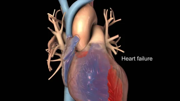 Иллюстрация Сердечной Недостаточности — стоковое фото