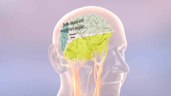 Cervello Umano Sano Cervello Con Malattia Alzheimer — Foto Stock